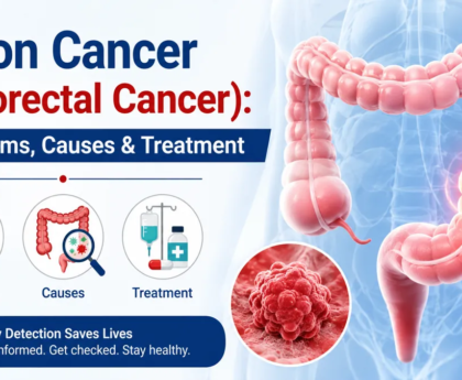 Colon Cancer (Colorectal Cancer) Symptoms, Causes & Treatment Options